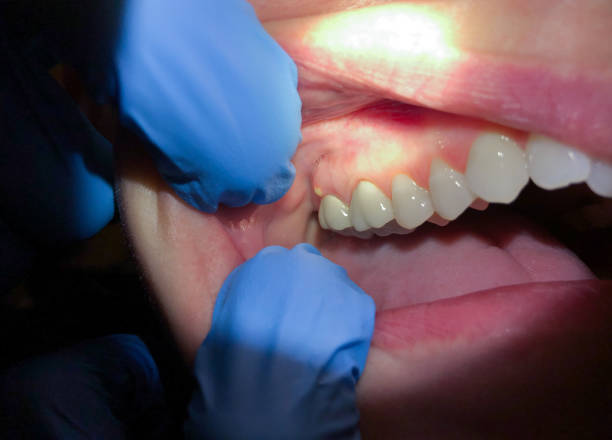 Best Same-Day Emergency Dental Services in Moreauville, LA